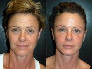 Как векторный лифтинг помогает чувствовать себя моложе — Ревда-инфо.ру